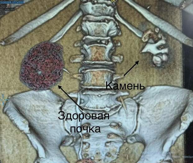 Врачи НИИ Джанелидзе удалили почку петербурженке из‑за гигантского "коралла"