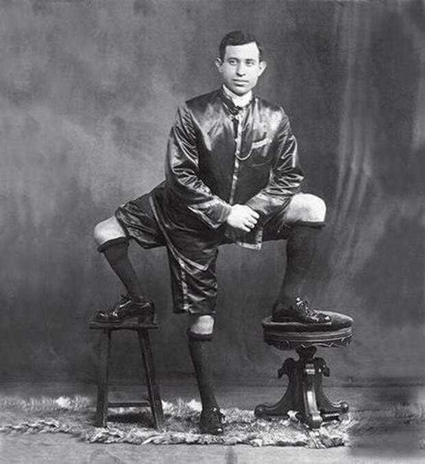 Франческо Лентини (Francesco A. Lentini) — человек родившийся с тремя ногами (1)