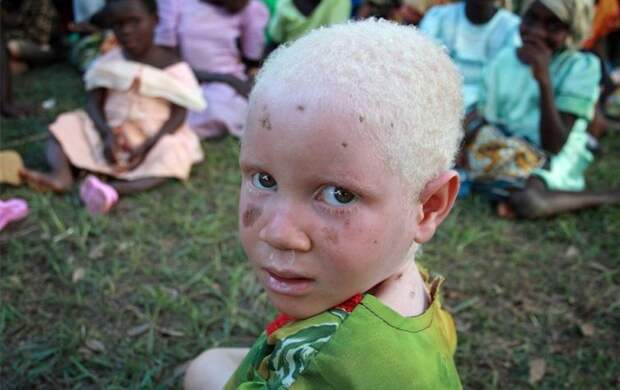 Тяжёлая жизнь африканских негров-альбиносов