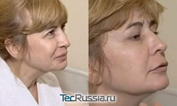 Татьяна кахидзе фото до и после пластики