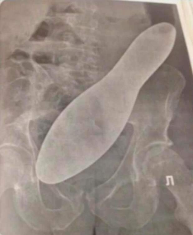 Рентгеновский снимок брюшной полости с инородным предметом