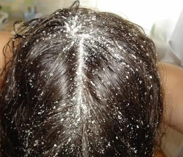 Могут ли выпадать волосы из-за шампуня от перхоти