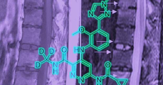 Первый селективный ингибитор TYK2: FDA утвердила deucravacitinib (Sotyktu) для лечения псориатического артрита