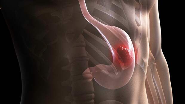 «Изменение пищевых привычек»: учёные — о неявных симптомах рака желудка и выявлении заболевания