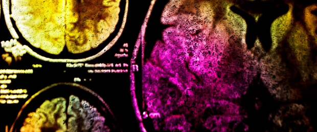 Терапия инфракрасным излучением эффективно уничтожает рак мозга