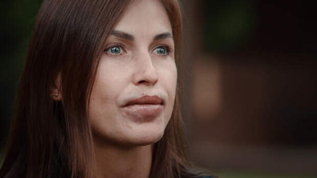 «Я не могла ни есть, ни пить»: как инъекции с вазелином едва не лишили женщин губ