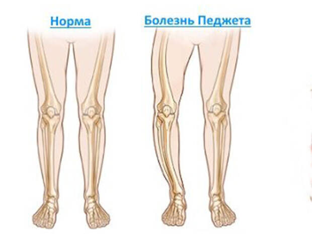 Остеопороз практически бессимптомен.-6