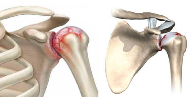 Ударно-волновая терапия (УВТ) как эффективный метод лечения артроза плечевого сустава