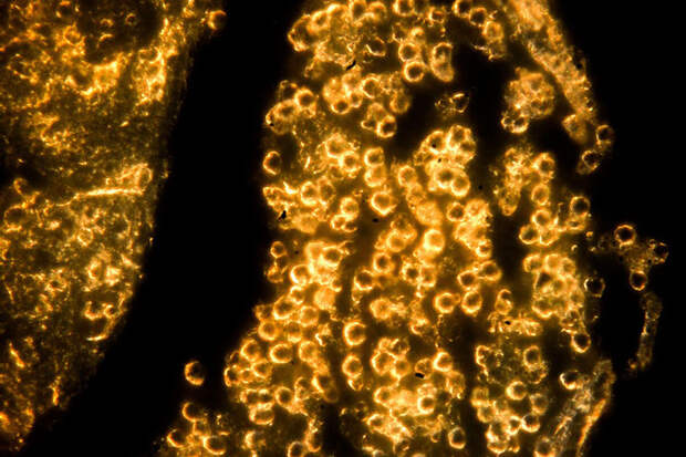 В России нашли безопасную замену золотым наночастицам для лечения рака