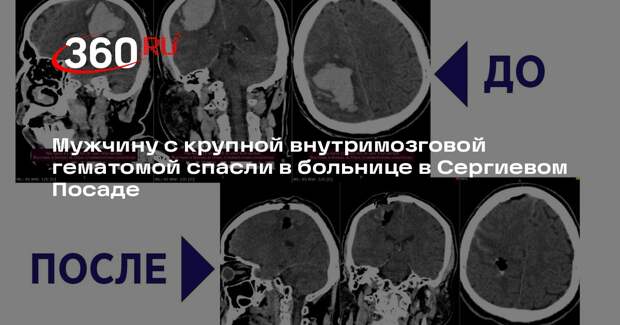 Мужчину с крупной внутримозговой гематомой спасли в больнице в Сергиевом Посаде
