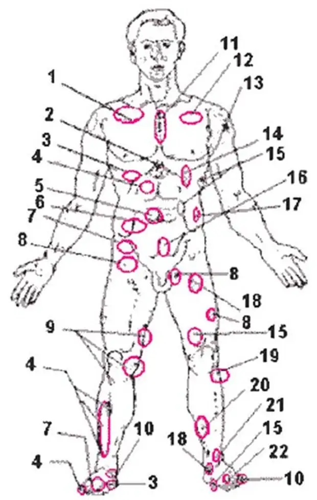 Различные точки тела. Схема ужаливания пчелами. Акупунктурные точки апитерапия. Точки для апитерапии на теле человека. Акупунктурные точки пчелоужаливания.