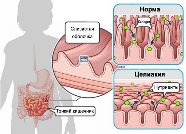 13 неочевидных признаков того, что у вас или ребёнка непереносимость глютена, которые важно знать