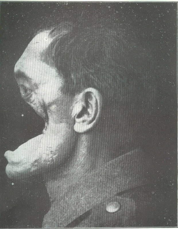 2. Ужасающая (и практически смертельная) травма немецкого солдата во время Первой мировой войны винтаж, крипи, фото