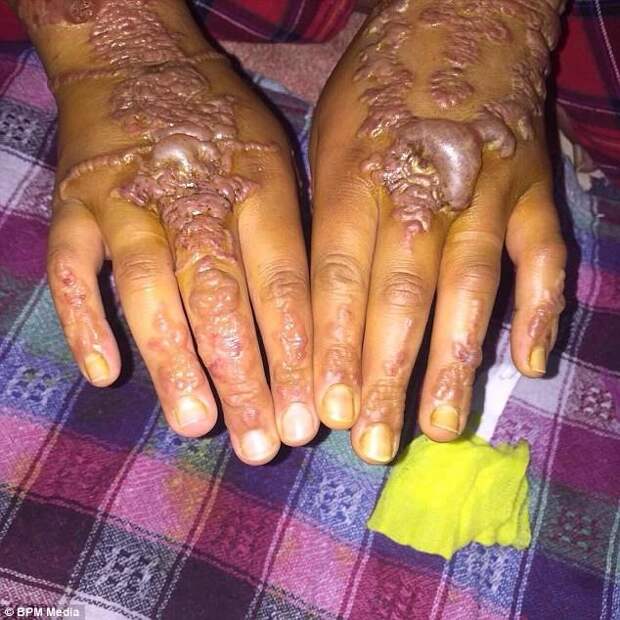 Эти картинки не для того, чтобы вас напугать, а для того, чтобы предостеречь от подобных ошибок аллергия, татуировка хной, черная хна