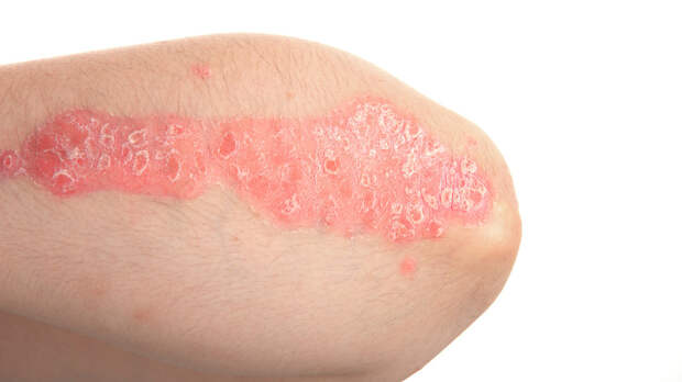 Терапевт Лапа посоветовала не игнорировать холодовый дерматит