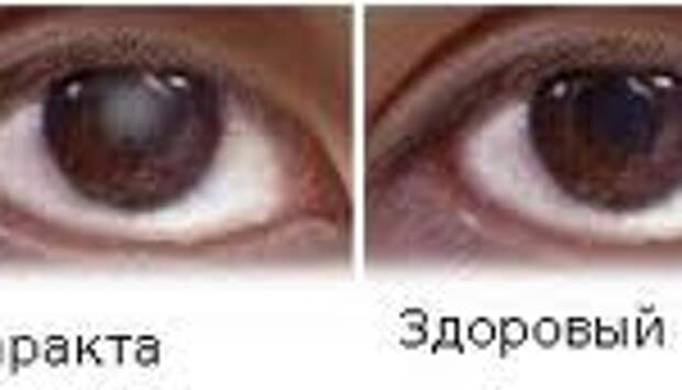 Что после катаракты нельзя делать. Мир глазами человека с катарактой. Как видит человек при катаракте.