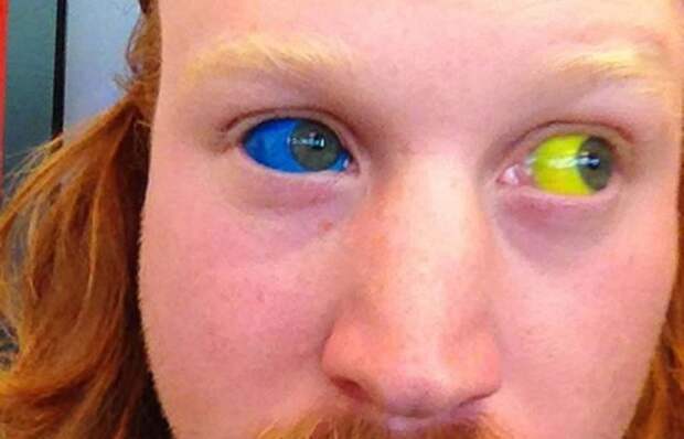 Инъекции пигмента в белок человеческого глаза.
