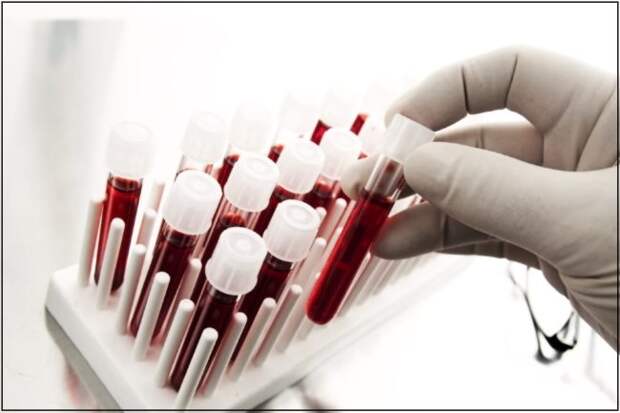 Причины вязкости крови у человека. Как определить показатель вязкости крови, какой анализ сдать, расшифровка и нормы