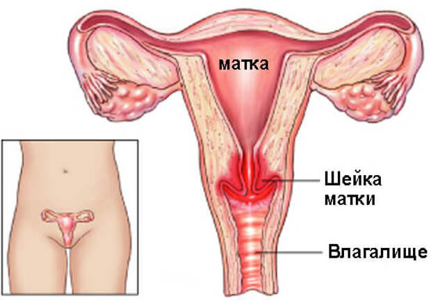 Хронический цервикоз шейки матки – симптомы и лечение. 
