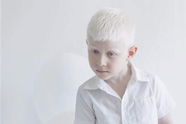 albinos_9