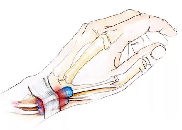 Ударно-волновая терапия как эффективный метод лечения болезни Де Кервена