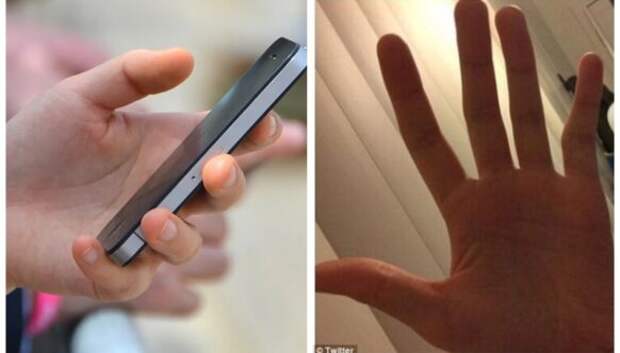 Смарт-мизинец: у пользователей смартфонов все чаще встречается деформация пальца