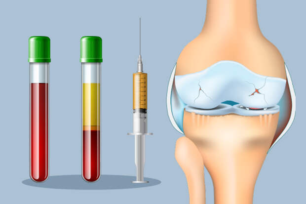 Плазмолифтинг суставов в Тюмени