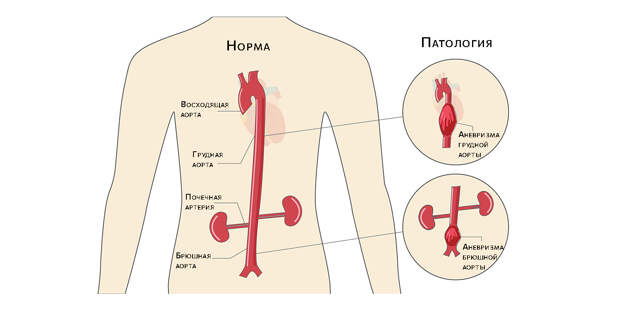Аневризма аорты: в груди и в брюшной полости