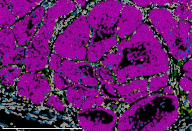 В первичных опухолях молочной железы нашли клетки с метастатическим потенциалом